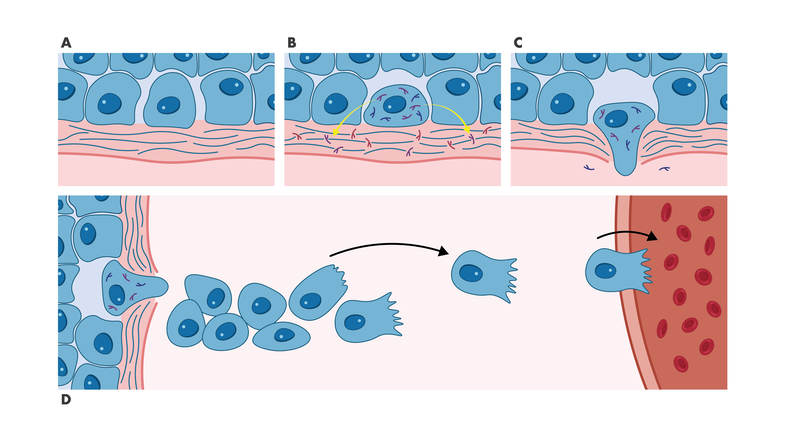 process of cell transformation, migration and invastion leading to metastasis