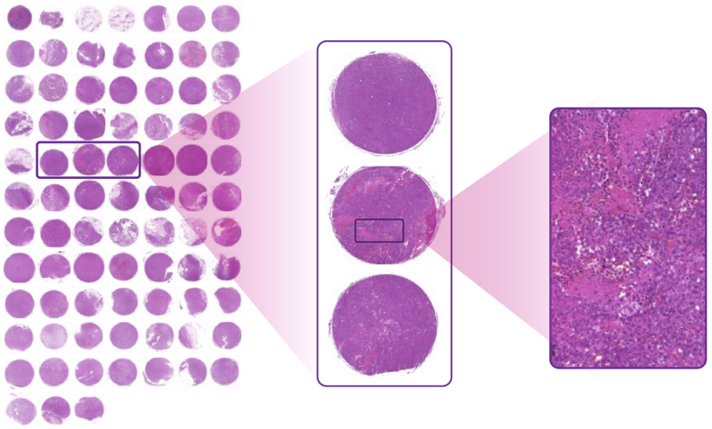 tumor tissue microarray